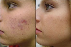 acne-juvenil