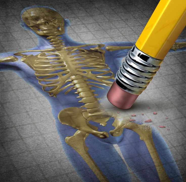 Osteoporosis: verdades y mentiras sobre esta enfermedad