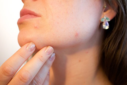 El acné, una patología dermatológica ¿Por qué aparece?