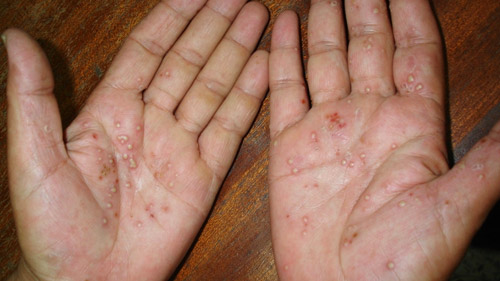 Psoriasis: Piel enferma. Desencadenantes y su tratamiento