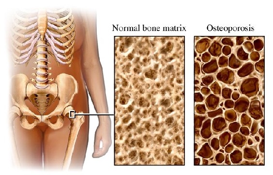 ¿Qué es y cómo se produce la osteoporosis?
