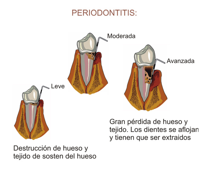 Periodontitis o Piorrea