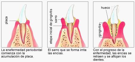 Piorrea o Periodontitis